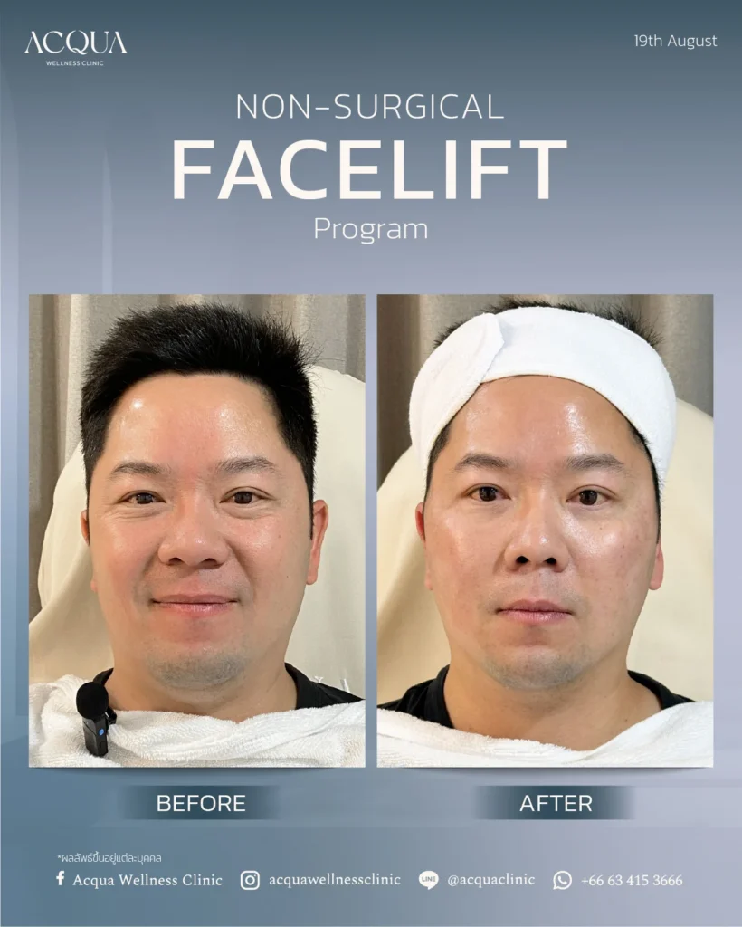 Thread Lift Swelling: How Many Days?