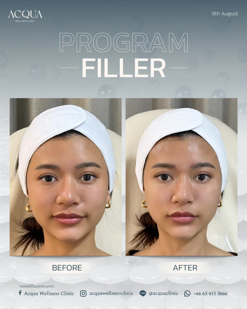 How Long Does Under-Eye Filler Last?