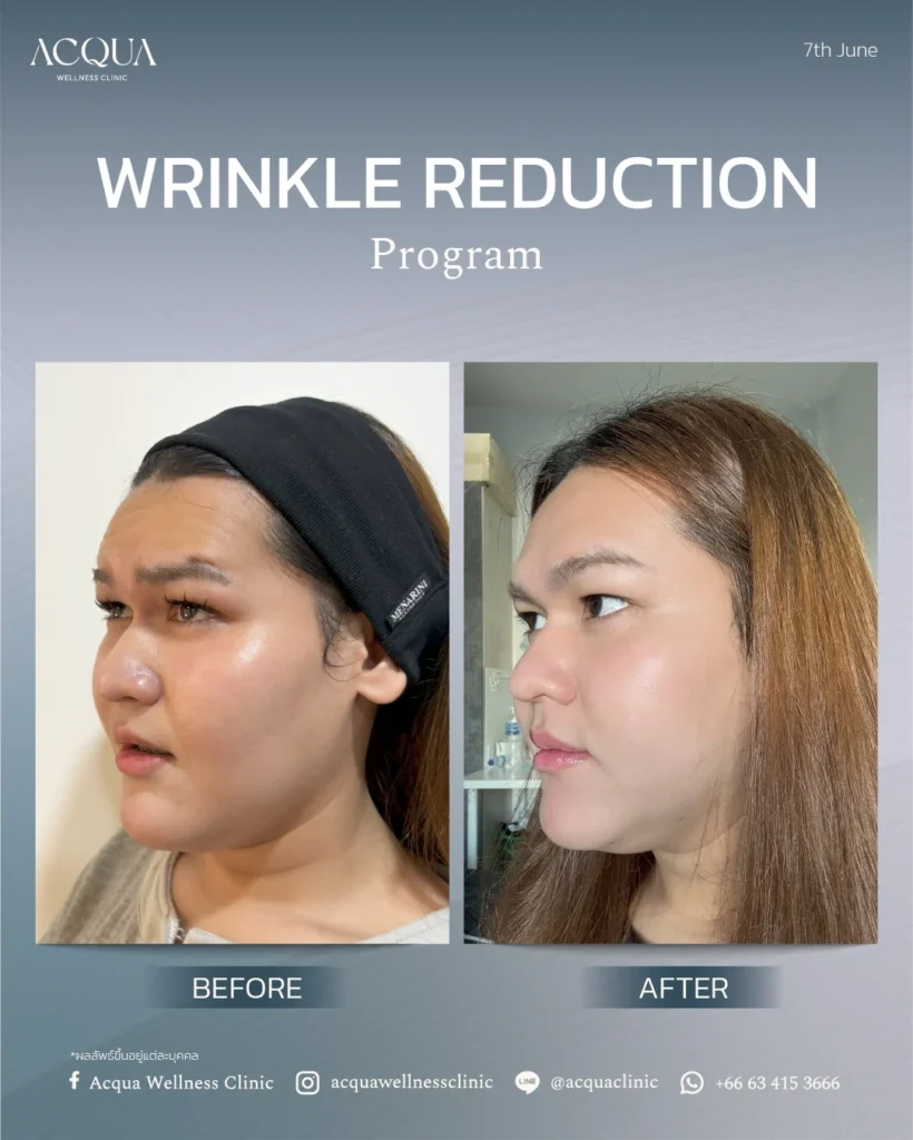 wrinkle reduction Program