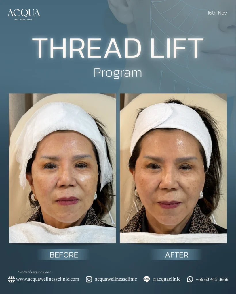 Facial Lifting Program