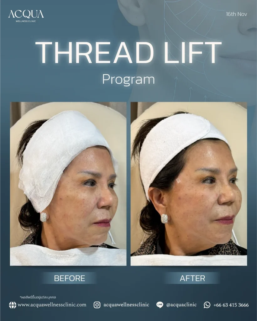 Facial Lifting Program