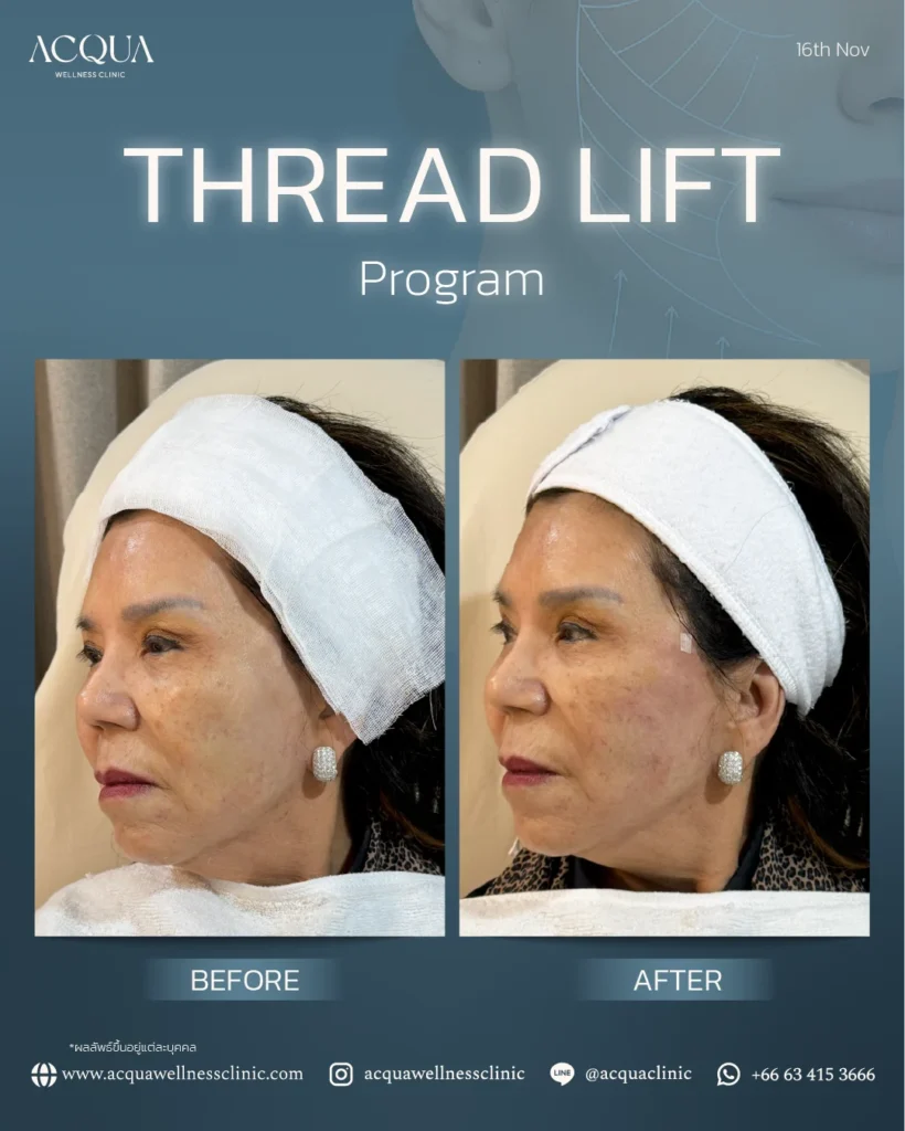 Facial Lifting Program