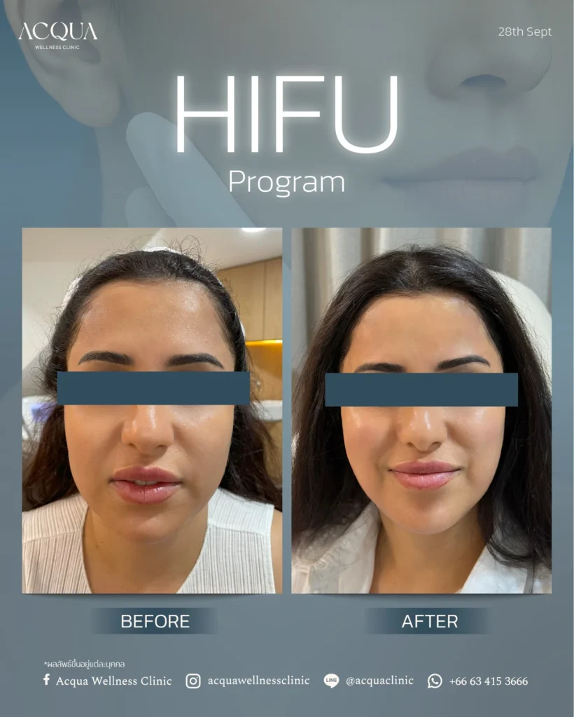 HIFU program
