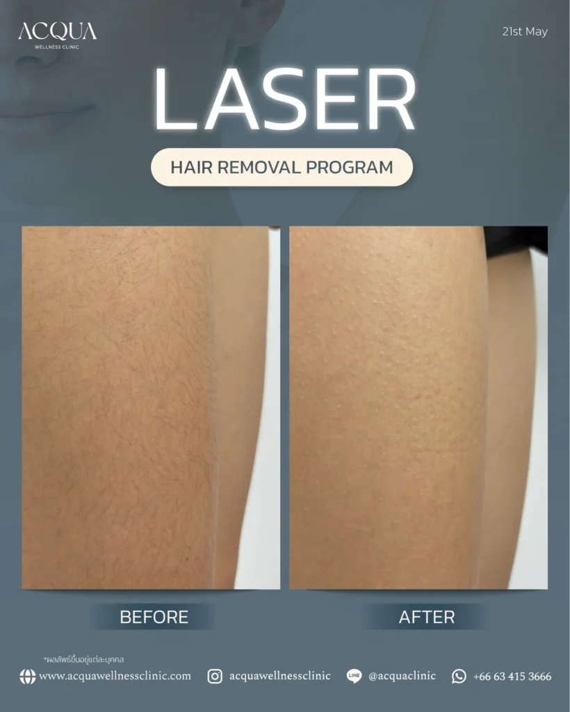 Laser hair removal