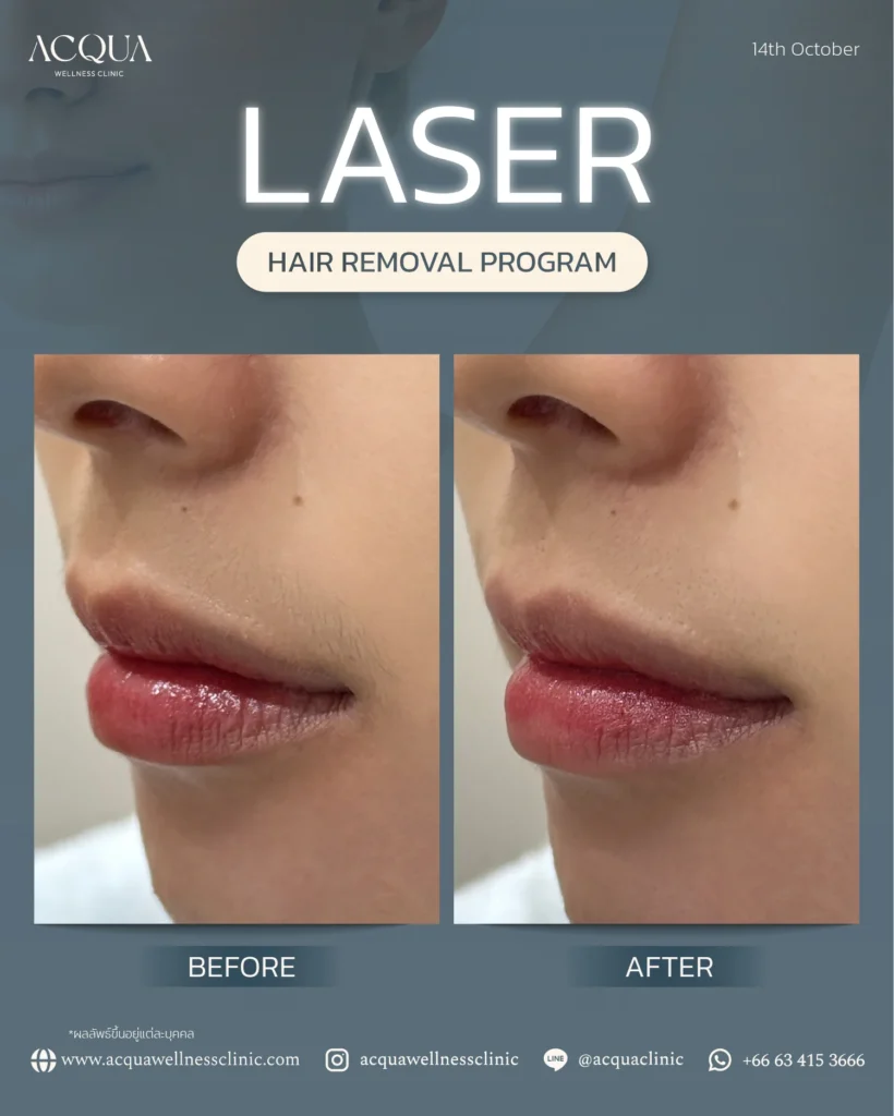 Laser hair removal