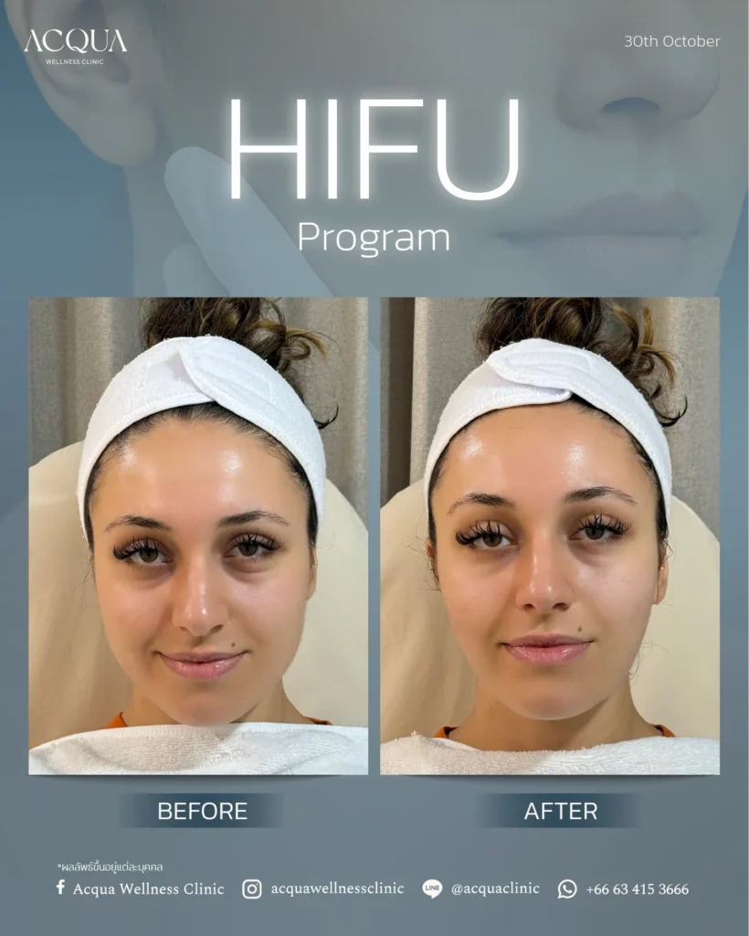 HIFU program