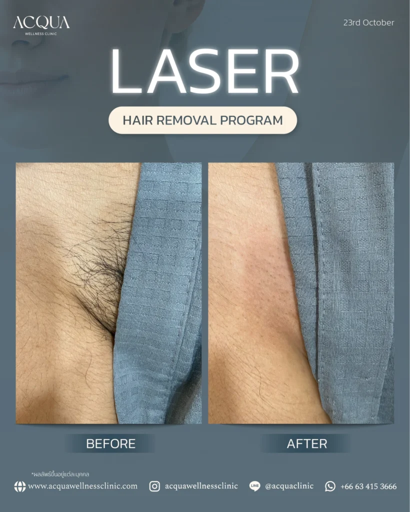 Laser hair removal